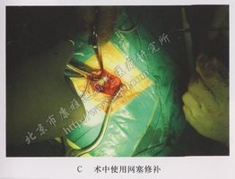 小肠疝气手术图片C