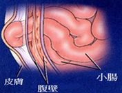 小儿疝气图片A