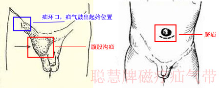 疝气图片（腹股沟疝及脐疝）