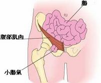 小肠疝气症状与图片