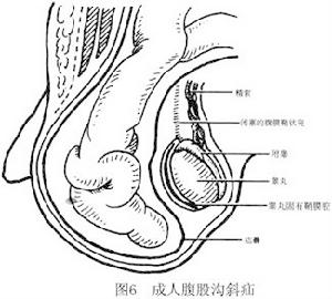 成年人腹股沟斜疝介绍