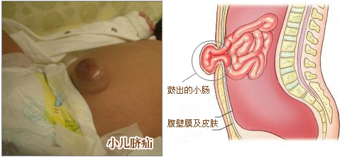 小儿疝气原因、症状及治疗方法