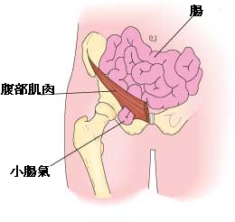 得了疝气有哪些症状