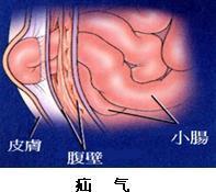 疝气的主要表现有哪些