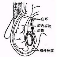 腹股沟疝气掉入阴囊怎么办