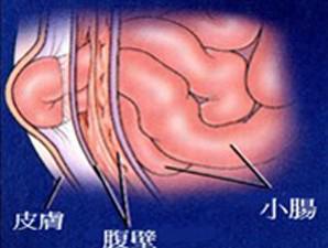 疝气对身体有什么影响