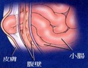 小肠疝气症状有哪些